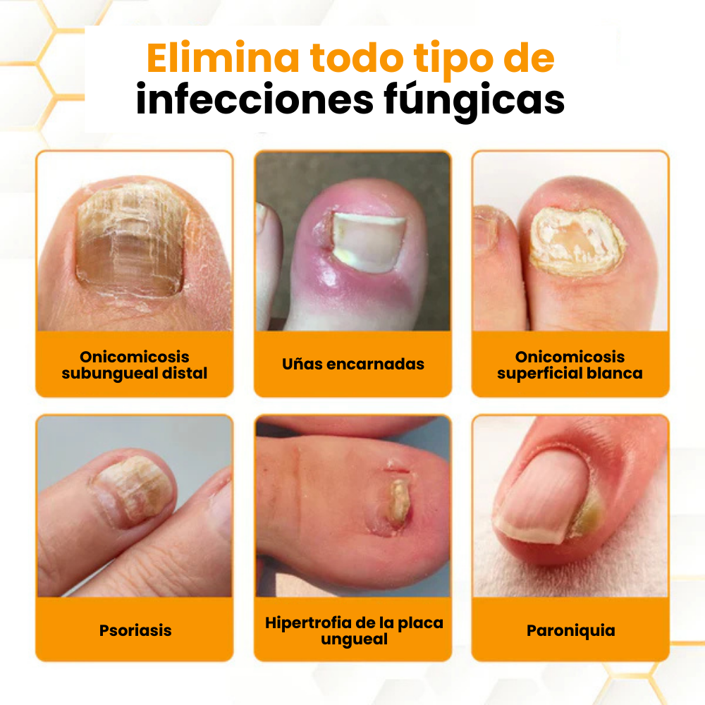 BeeVenom™- Aceite Anti-Hongos Uñas