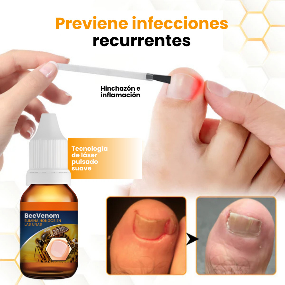 BeeVenom™- Aceite Anti-Hongos Uñas